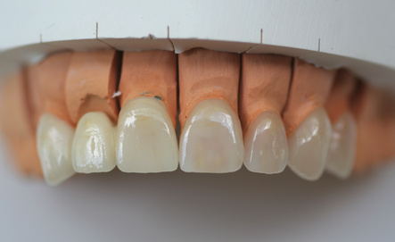 Versorgung des Zahnes mit Frontal-Zahnkronen und Veneers